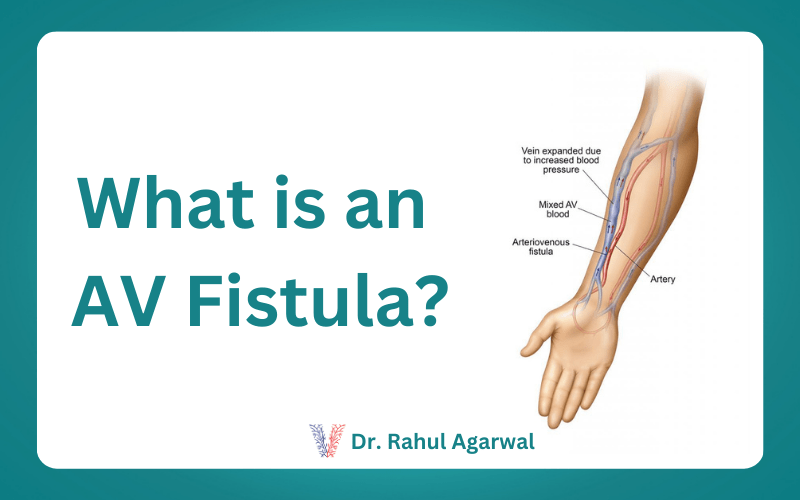 what-is-an-av-fistula